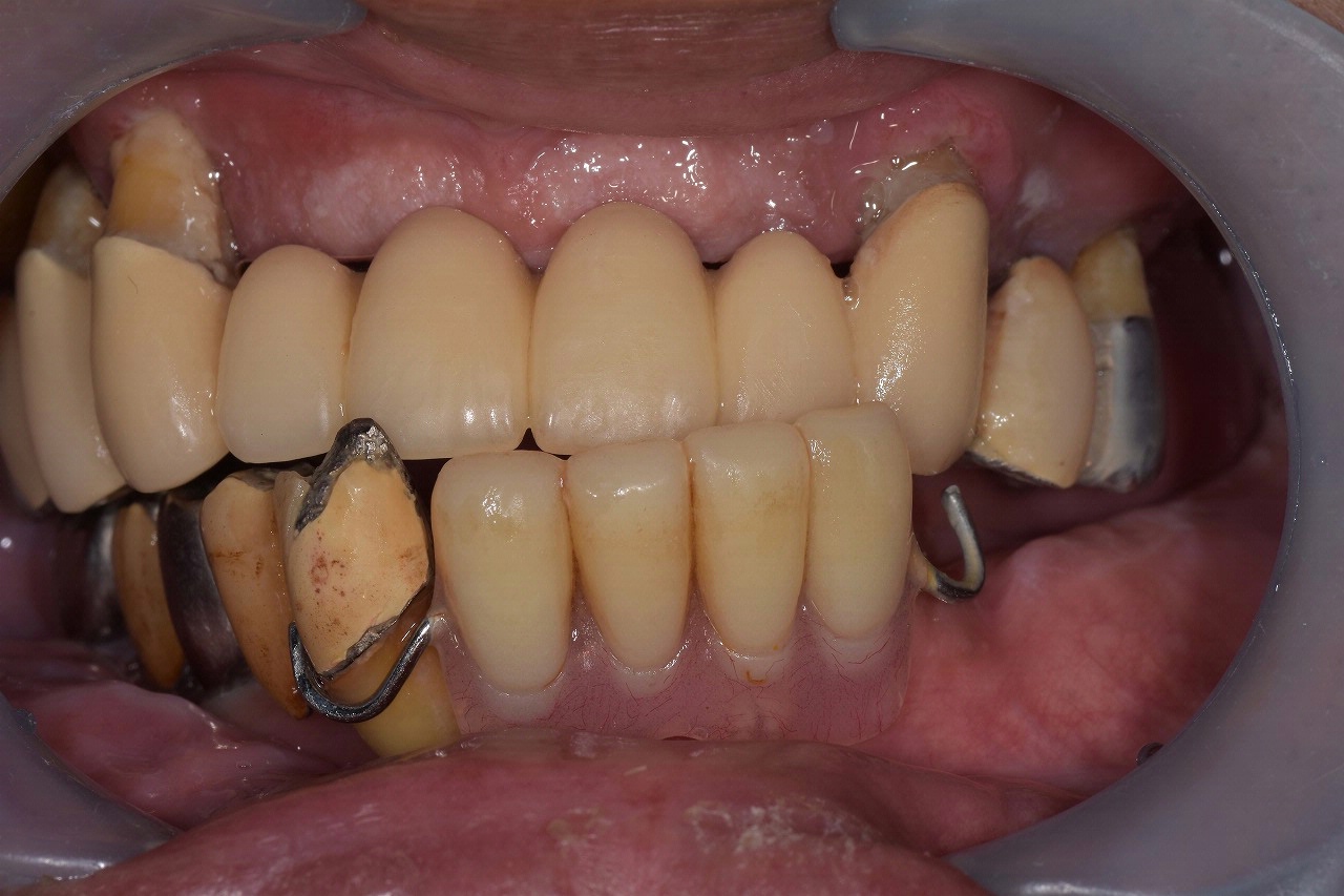 藤沢の歯科の総義歯（総入れ歯）症例