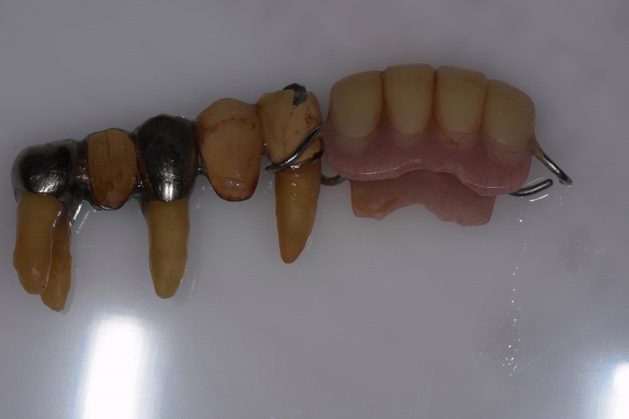 藤沢の歯科の総義歯（総入れ歯）症例