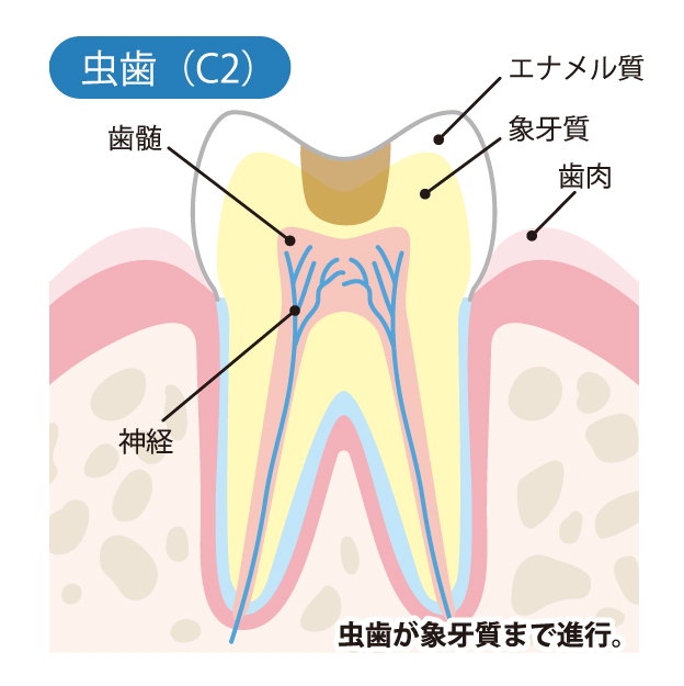 藤沢の歯医者で虫歯治療