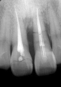藤沢の歯医者の外傷欠損に対するインプラント症例