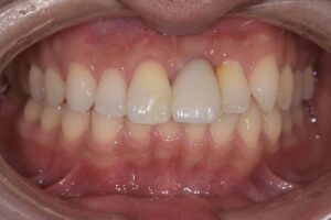 藤沢の歯医者の外傷欠損に対するインプラント症例